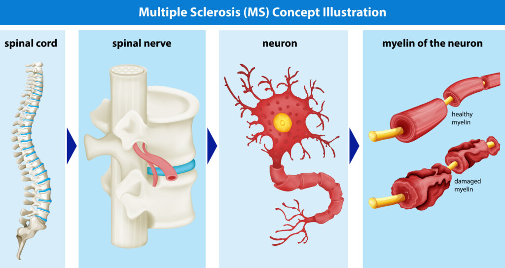 Multiple sclerosis is caused by an autoimmune condition in which the immune system attacks the myelin surrounding the nerves. This causes damage to the neurons.