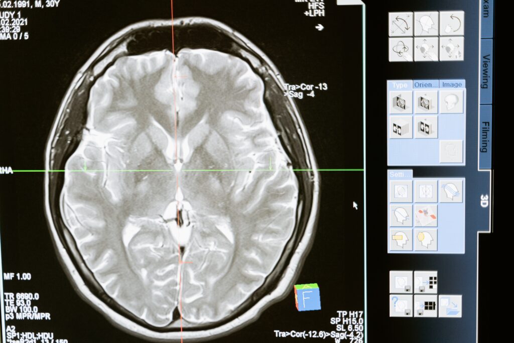 MRI for Seizures 